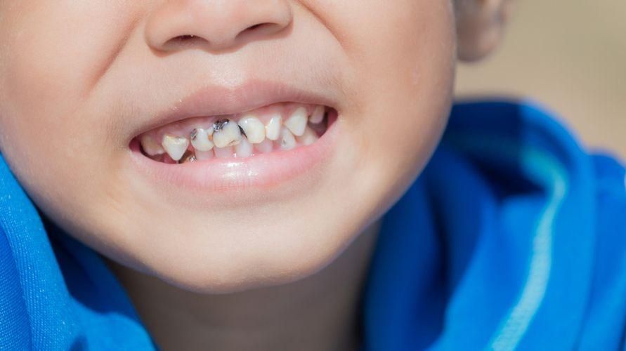 שיניים שחורות בילדים, זיהוי הסיבה וכיצד להתגבר עליה