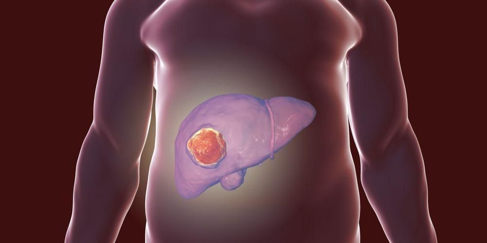 Comprensión de los tumores hepáticos, que pueden ser benignos pero también pueden ser cáncer