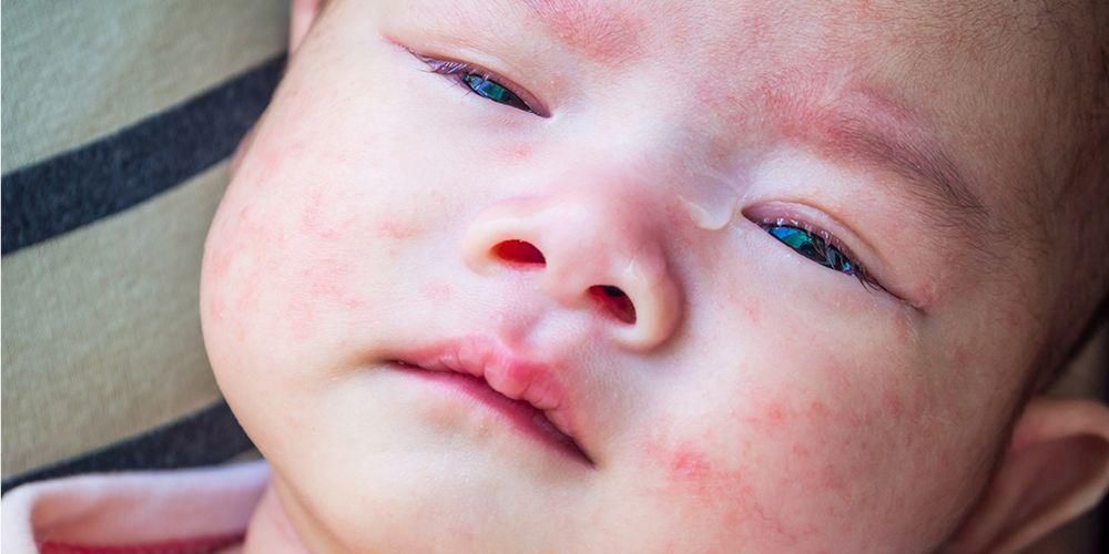 La alergia a la leche y la intolerancia a la lactosa en los bebés resultan diferentes, ¡he aquí cómo comprobarlo!