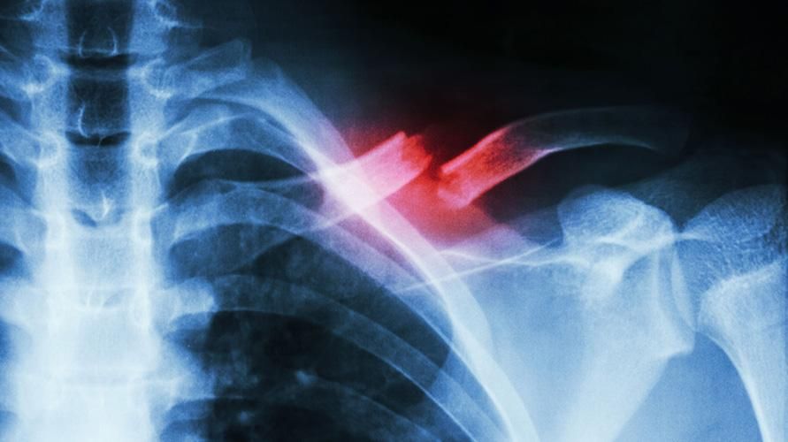 Causas de la fractura de clavícula y cómo tratarla
