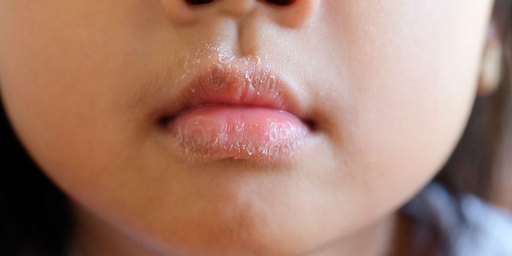 Haben Sie häufig rissige Lippen? Vorsicht vor Dermatitis auf den Lippen