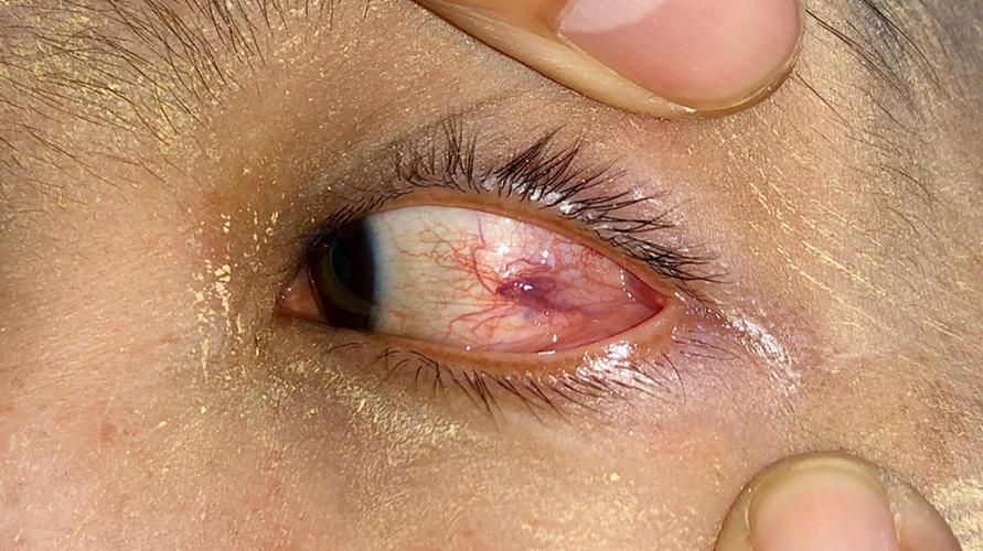Loa-Loa-Wurminfektion im Auge, was verursacht sie und wie wird sie behandelt?