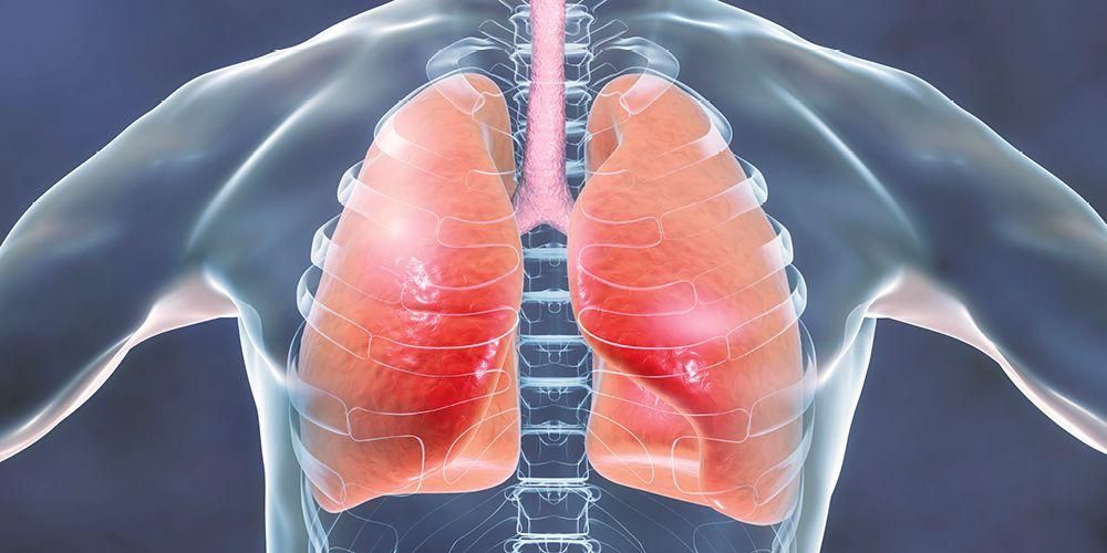 Upoznajte se s simptomima upale pluća na koje trebate pripaziti