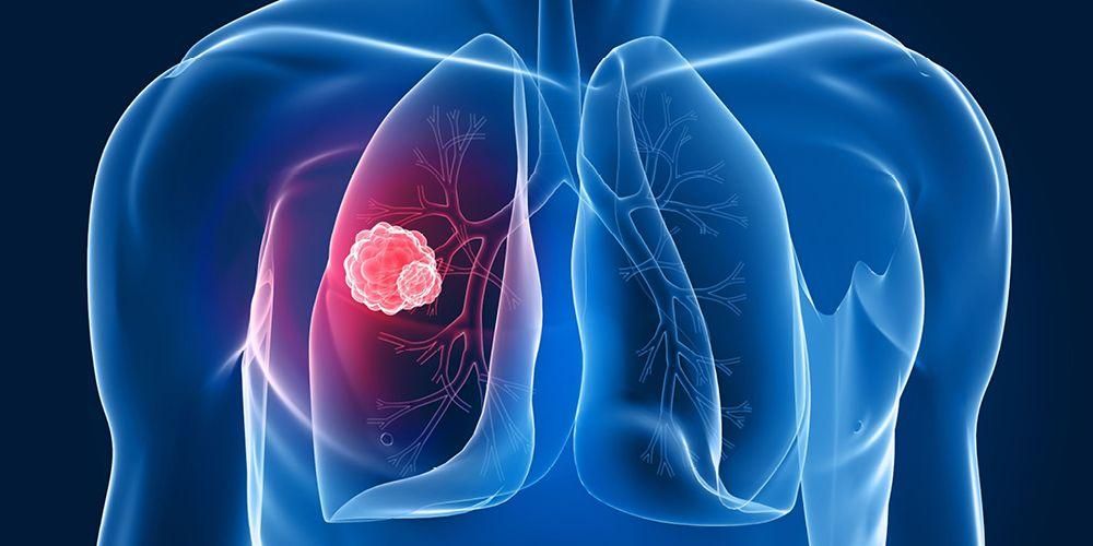 폐 종양이 항상 폐암의 징후는 아닙니다. 설명이 있습니다.