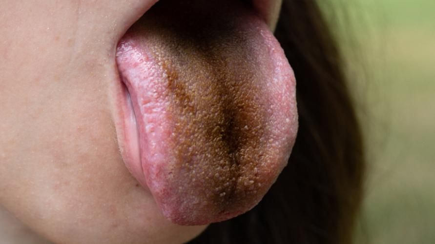 검은 혀의 7 가지 가능한 원인, 위험합니까?