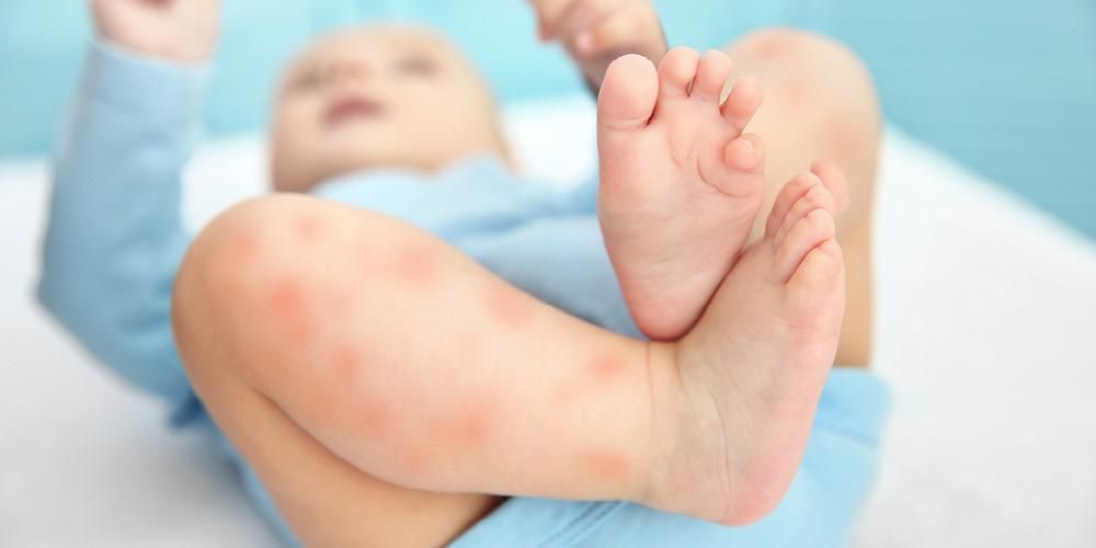 자주 나타나는 아기의 피부병 유형 11가지
