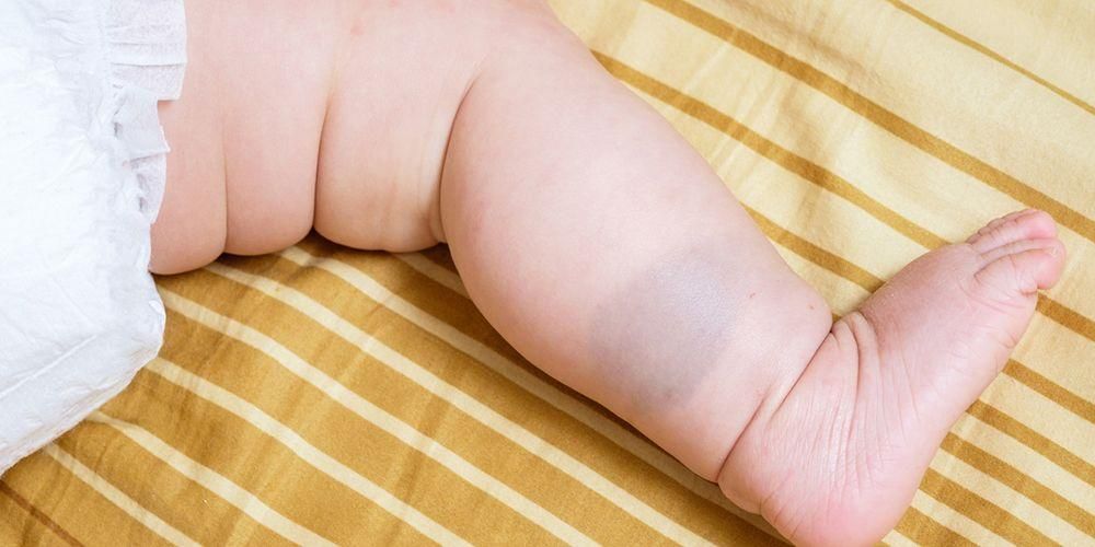 Vrste rodnih maraka kod beba koje roditelji moraju znati