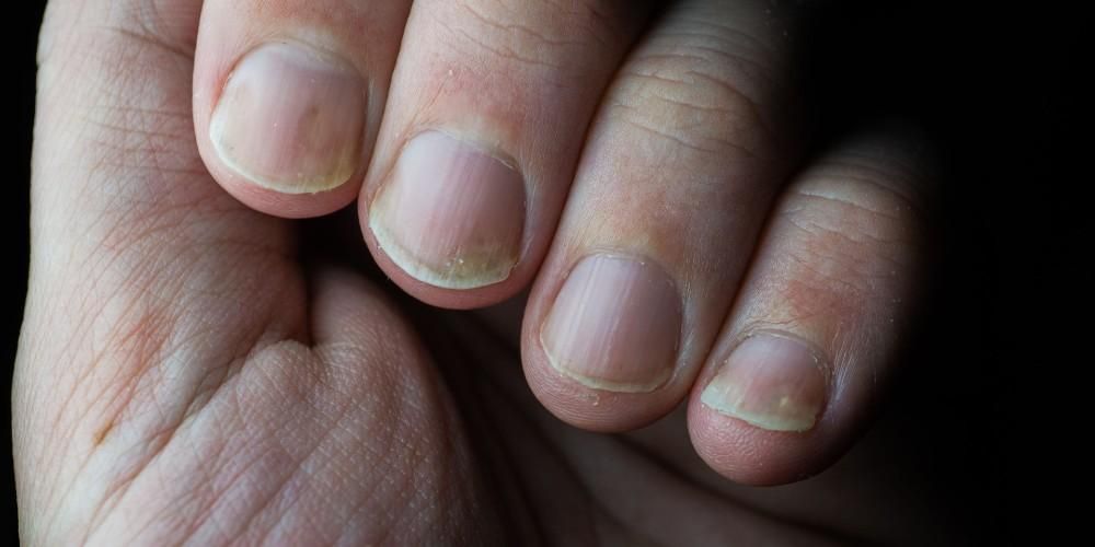 Connaître les signes du psoriasis des ongles et comment le surmonter