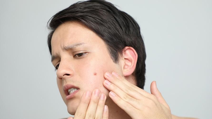 Deze 3 dingen zijn de sleutel tot het verschil tussen steenpuisten en acne