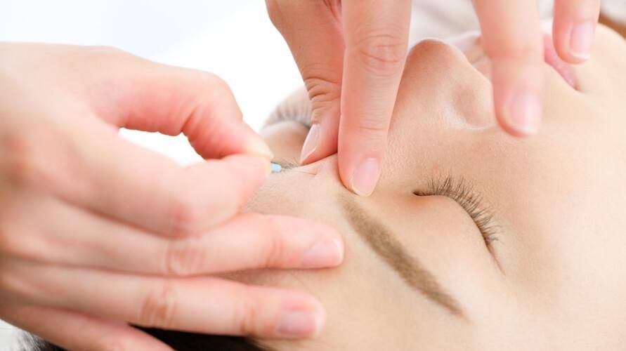 Apprenez à connaître les points d'acupuncture pour les maux de tête et leurs avantages