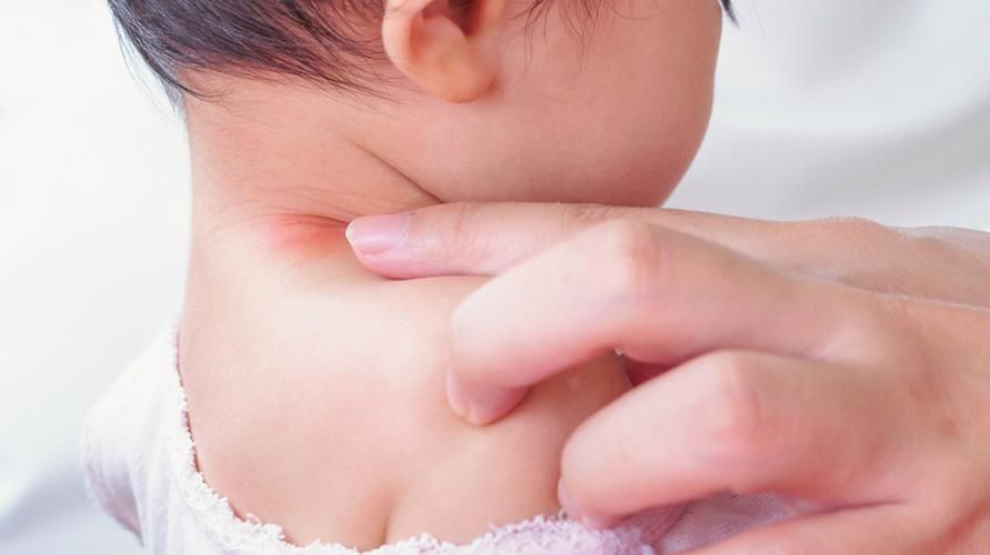 Ampollas en el cuello del bebé, estas causas y cómo superarlas