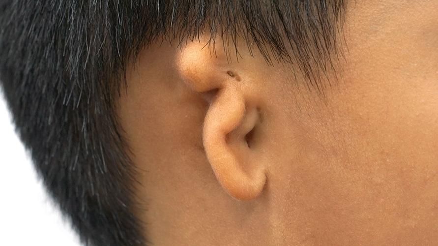 Мікротія - це вроджений дефект, який викликає втрату слуху у немовлят