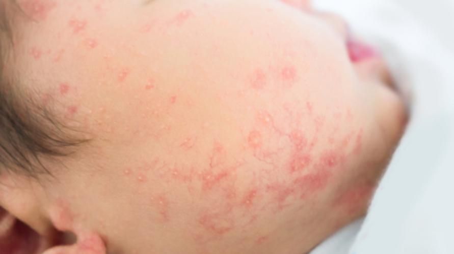 의사가 추천할 수 있는 6가지 아기 알레르기 검사 방법