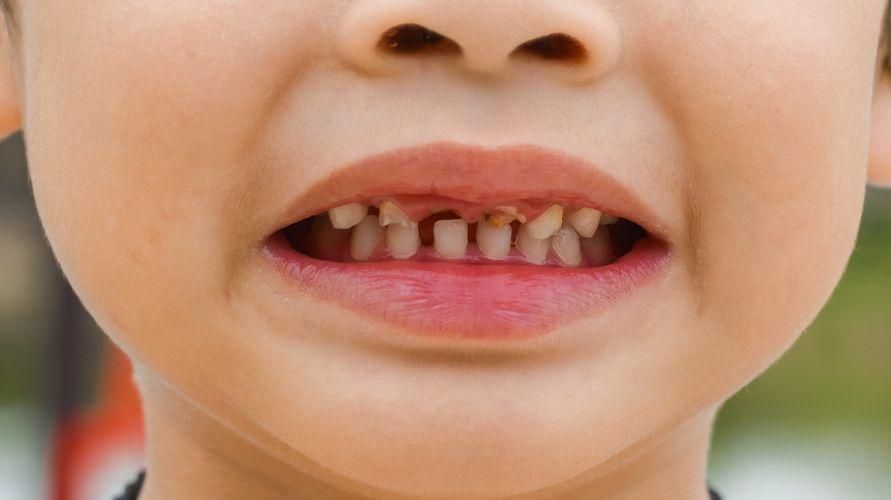 Cauzele cariilor la dinții copiilor și cum să le tratezi corect