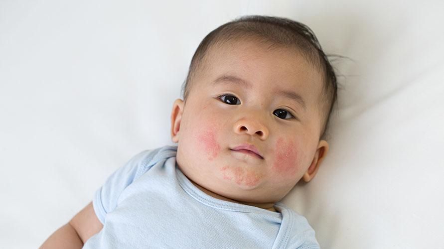 우유 습진으로 인한 아기의 붉은 뺨, 정말 모유 알레르기가 원인입니까?
