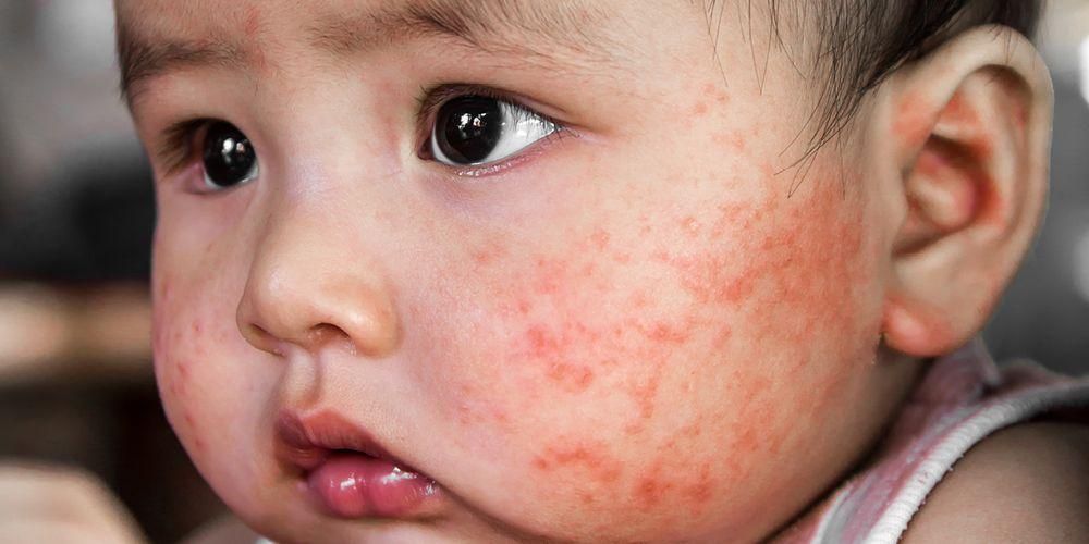 Розпізнавати різні форми алергії у дітей і як їх лікувати