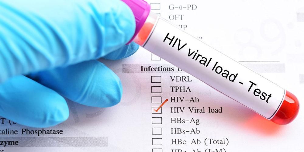 환자의 체내 바이러스 양 측정 시 HIV 바이러스 부하 파악