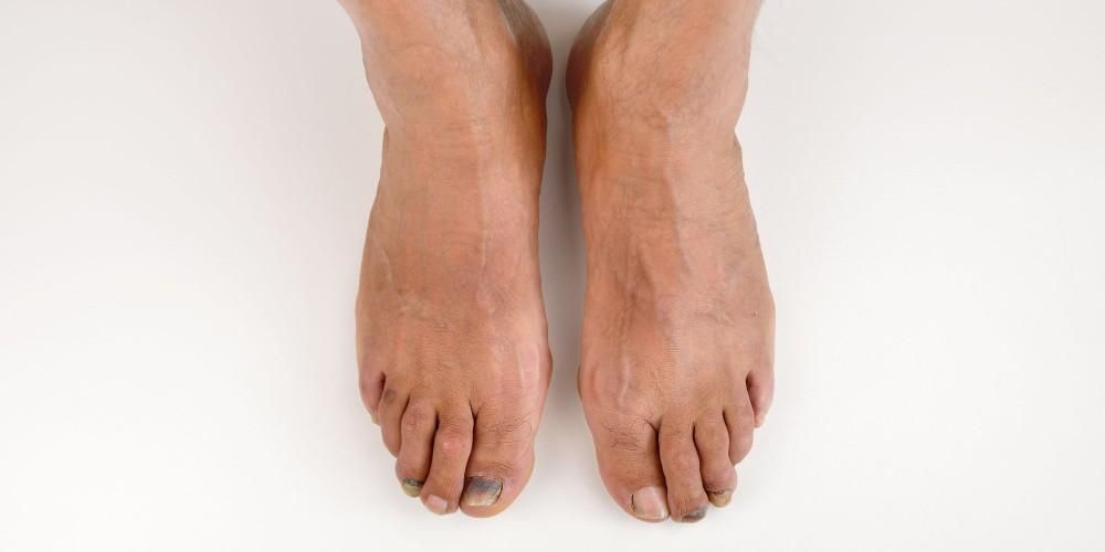Les orteils de Covid, de nouveaux symptômes de Covid-19 sous forme de lésions violettes sur les ongles des pieds