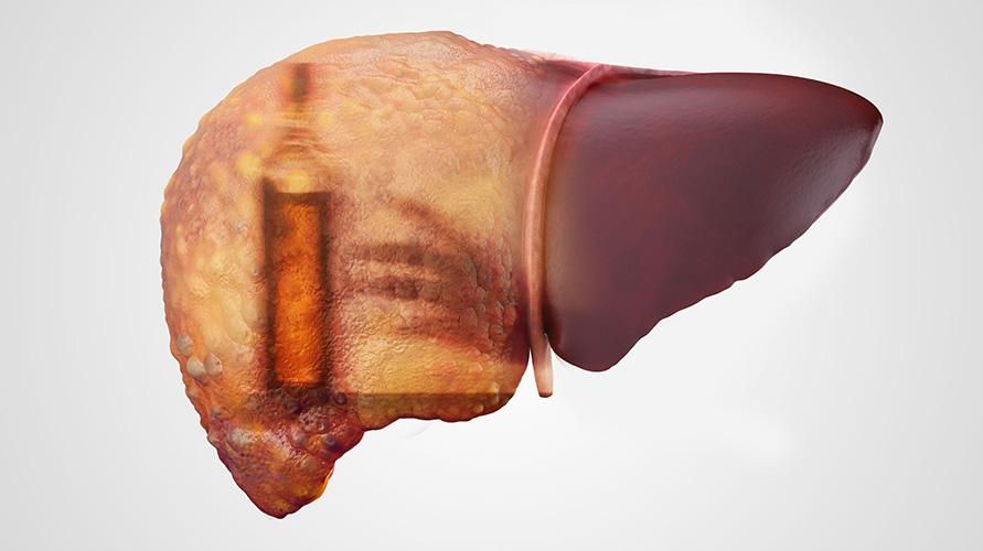 Ciroza hepatică: cauze, simptome și cum să o tratăm